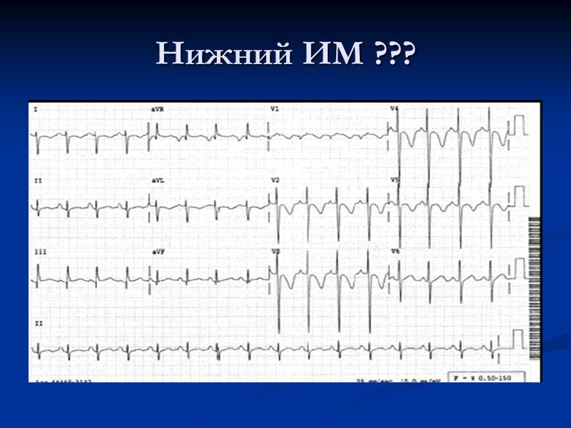 Нижний ИМ ???